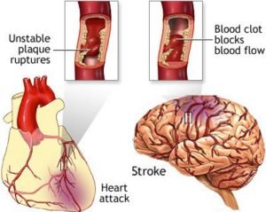 Acute Ischemic Stroke